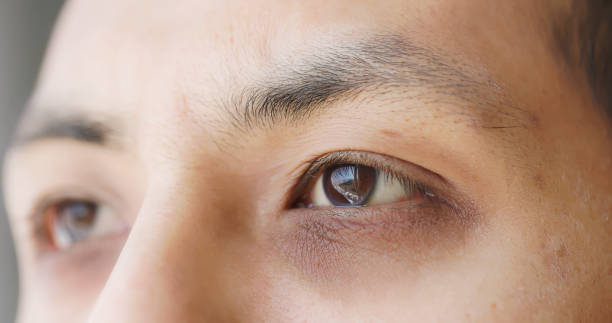 Read more about the article Dark Circles: Top Causes, Types & Real Ways to Get Rid of Them Naturally